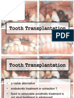 Tooth Transplantation