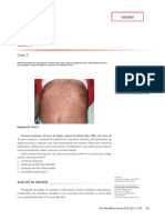 Caso de neurofibromatose tipo 1