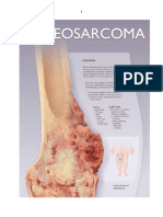 Proceso Osteosarcoma