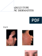 Adult-Type Atopic Dermatitis