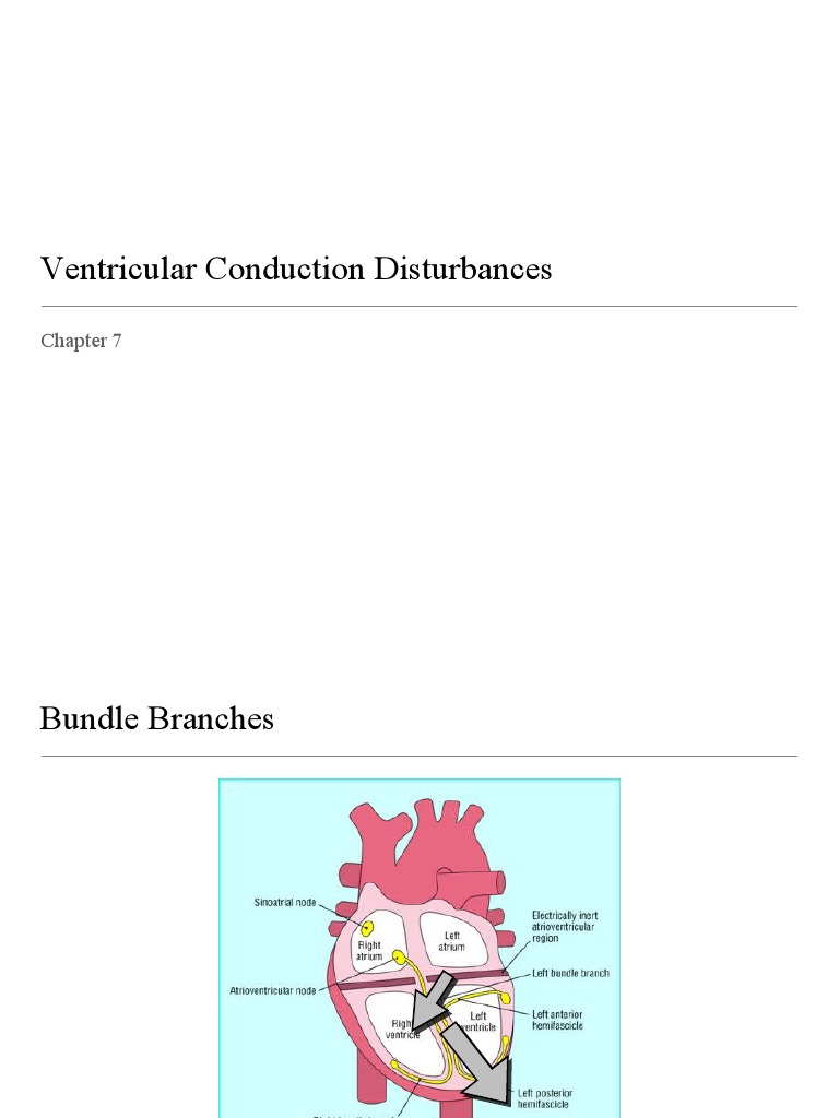 Ventricular Conduction Disturbances | PDF | Cardiac Electrophysiology ...