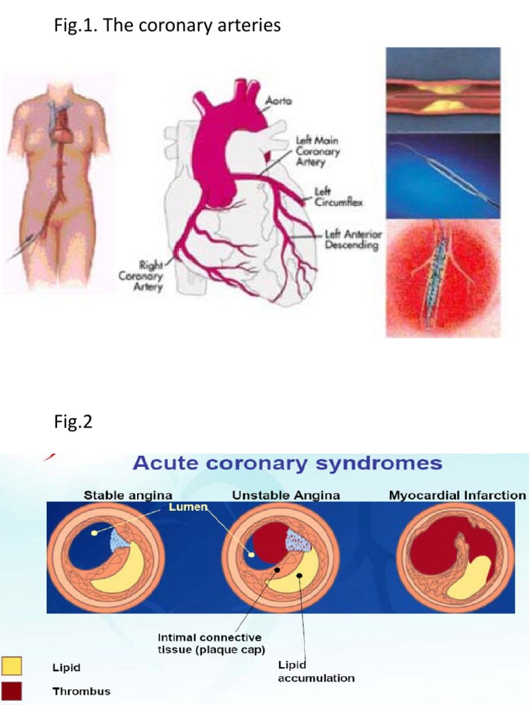 Angina Severity Classification and Diagnosis | PDF