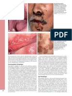 Fig. 29.10 Paraneoplastic Pemphigus. A The Characteristic