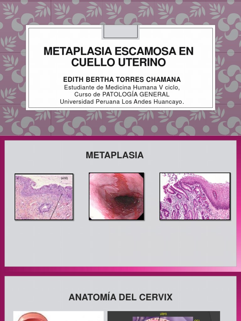 O Que É Cervicite Cronica Com Metaplasia Escamosa? – ZSON