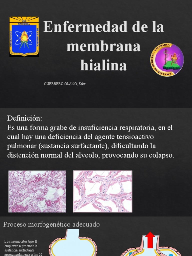 Enfermedad de La Membrana Hialina PDF