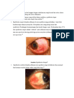 Episkleritis