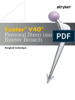 Exeter V40: Femoral Stem Using Exeter Broach