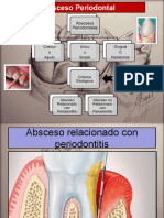 Absceso Periodontal