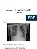 Latihan Ekspertisi Foto Rӧ Thorax