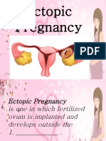 Ectopic Pregnancy: Gracy Espino