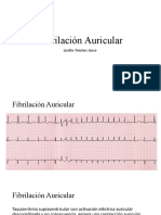 Fibrilación Auricular: Lizette Tróchez Lince