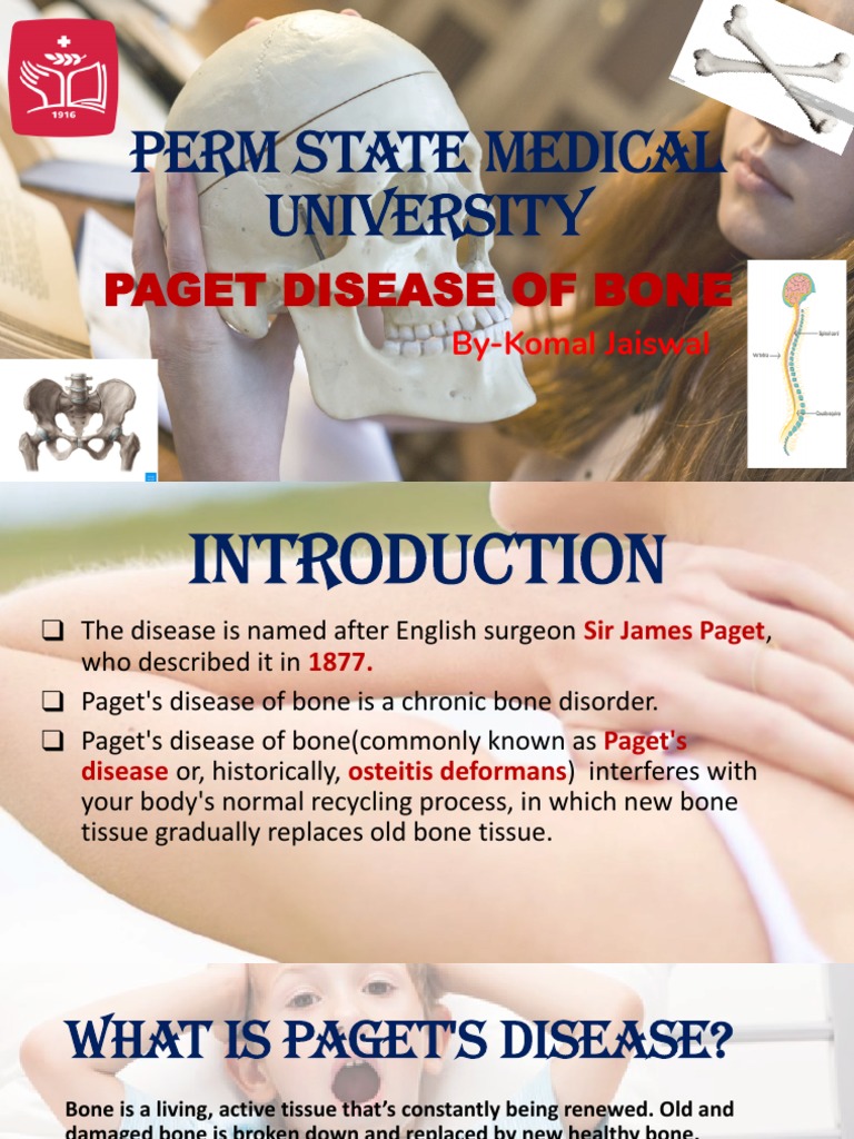 Paget's Disease of Bones PDF Bone Medicine