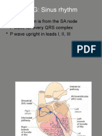 EKG Interpretation Guide for Sinus Rhythm, Arrhythmias & Blocks