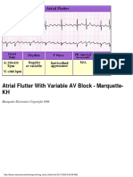 Atrial Flutter With Variable AV Block - Marquette-KH