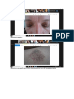 dermatosis con placa