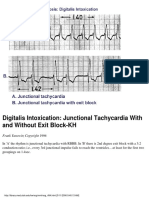 Digitalis Intoxication: Junctional Tachycardia With and Without Exit Block-KH