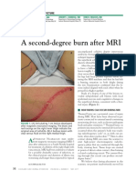 A Second-Degree Burn After MRI: The Clinical Picture