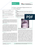 Extensive Amalgam Tattoo (Amalgam Pigmentation) On The Palatal Mucosa: A Case Report