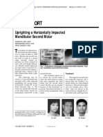 Case Report: Uprighting A Horizontally Impacted Mandibular Second Molar