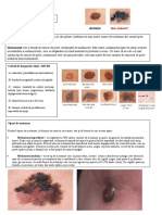 Melanomul Malign