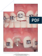 Orthodontic Extrusion With or Without Circumferemtial Spracrestal Fiberotomy and Root Planing