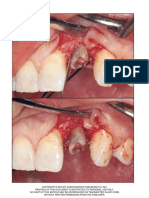 Surgical Extrusion Technique for Clinical Crown Lengthening