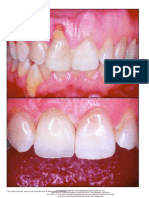 Esthetic Restoration with Orthodontic Traction and Single-Tooth Implant