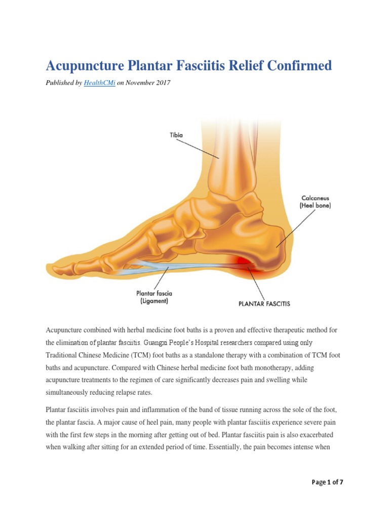 Acupuncture Plantar Fasciitis Relief Confirmed PDF PDF
