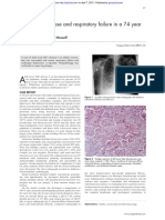 Adult Still's Disease and Respiratory Failure in A 74 Year Old Woman