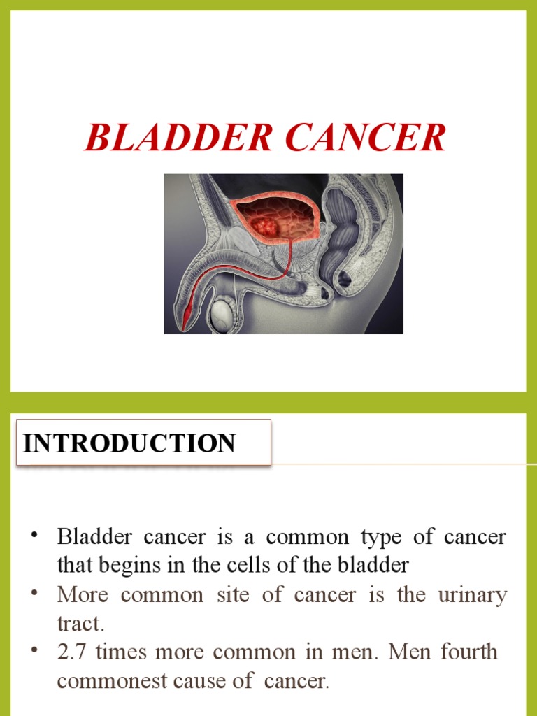 Overview of Bladder Cancer | PDF | Carcinoma | Cancer
