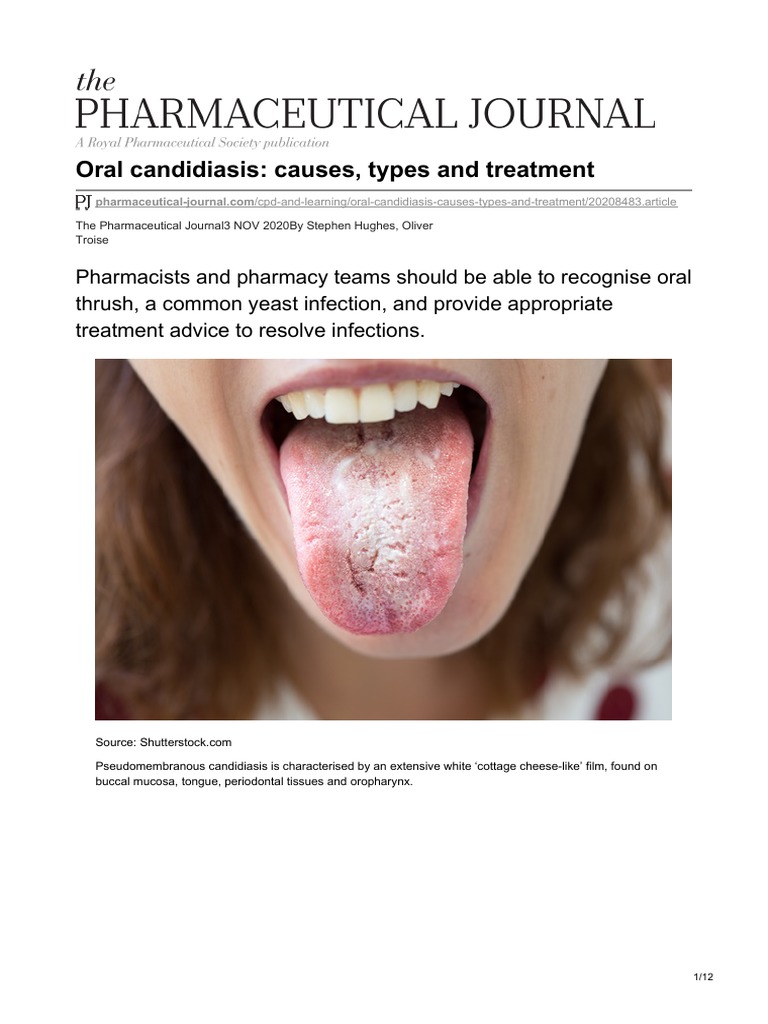 Oral Thrush vs. Normal Tongue and Other Conditions, image size:768x1024