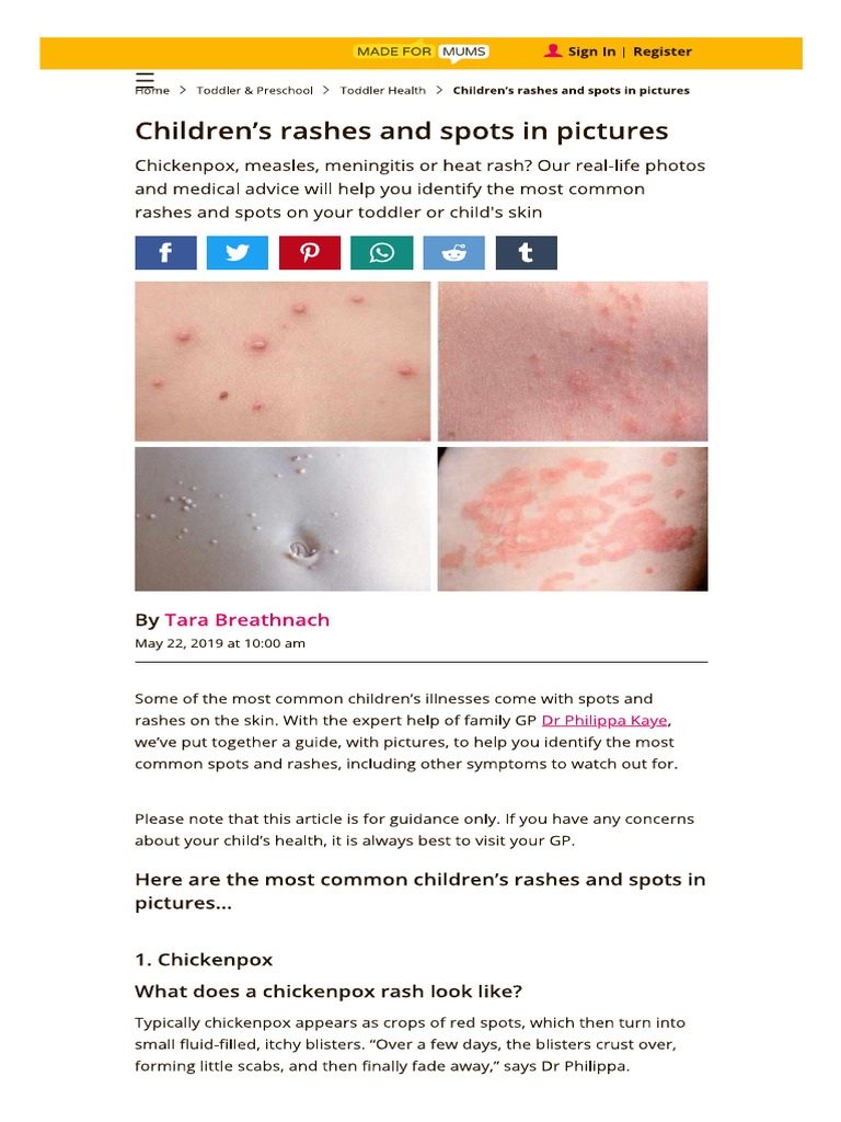 Children Rashes and Spots With Pictures - MadeForMums | PDF