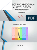 EKG patologico