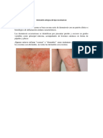 Dermatitis Alérgica de Tipo Eccematoso