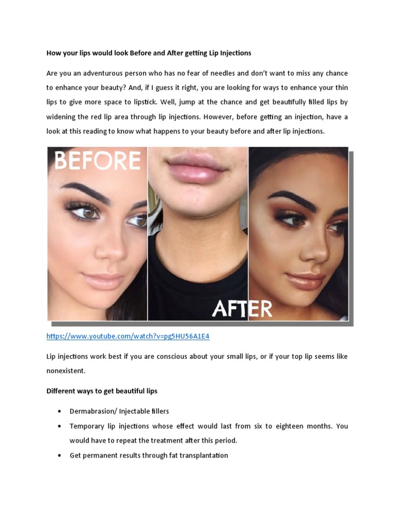 Before and After Lip Injections | PDF | Lip | Pain