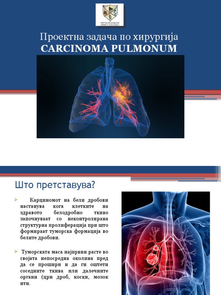карцином на бели дробови | PDF