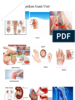 Akibat Penumpukan Asam Urat (PPT Skenario Blok3 Blok3) (Autosaved)