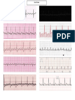 Atrial Flutter