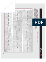 ECG 33