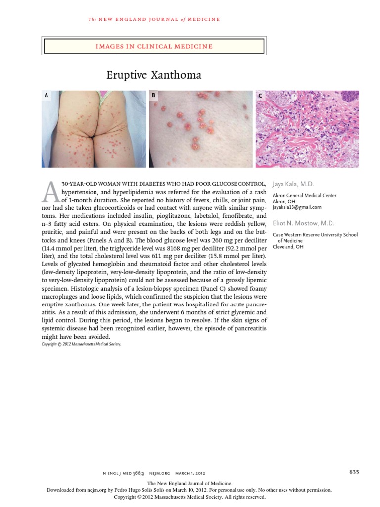 Eruptive Xanthoma Images in Clinical Medicine PDF Diseases And Disorders Disorders Of