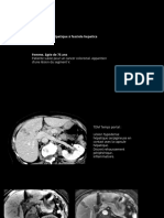 DISTOMATOSE HÉPATIQUE À FASCIOLA HEPATICA