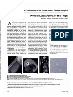 Myxoid: Liposarcoma of The Thigh