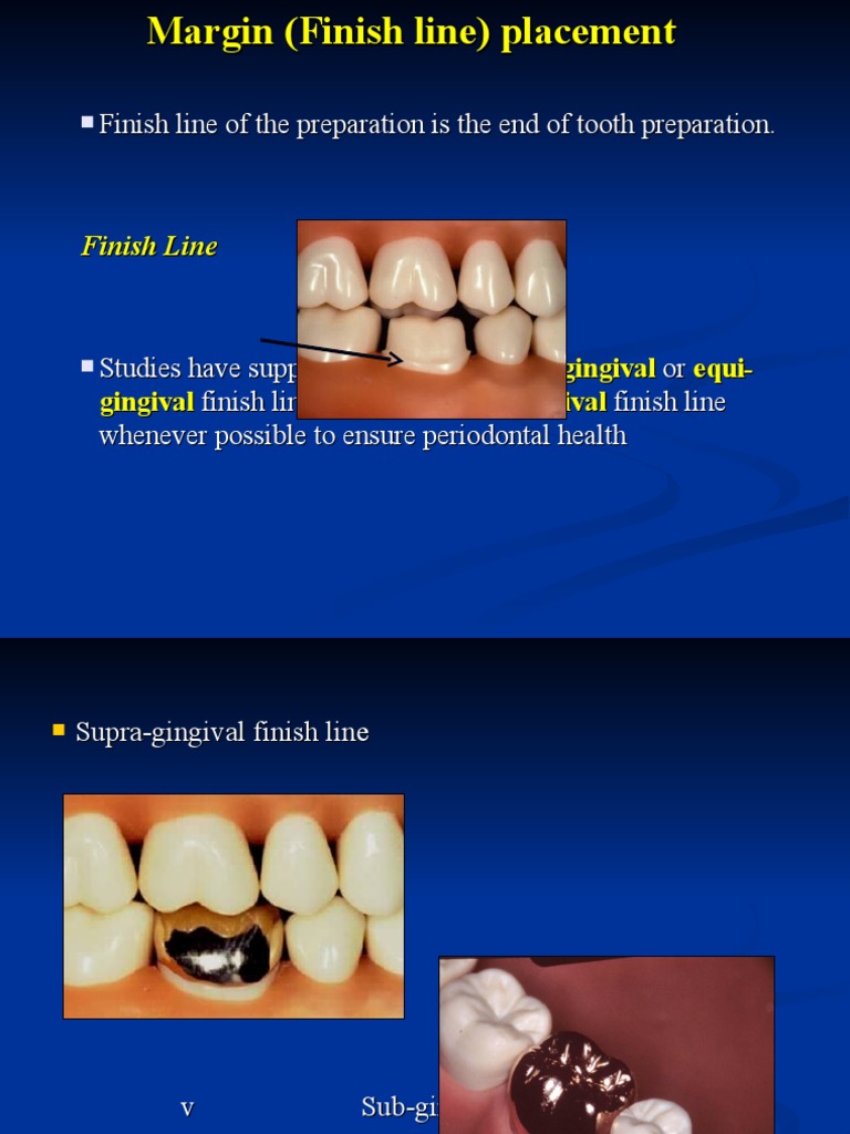 Margin (Finish Line) Placement PDF Dentistry Branches Medical