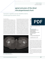 CSNN - 2020 2 3 - Spontaneous Vaginal Extrusion of The Distal Catheter of A Ventriculoperitoneal Shunt 121858