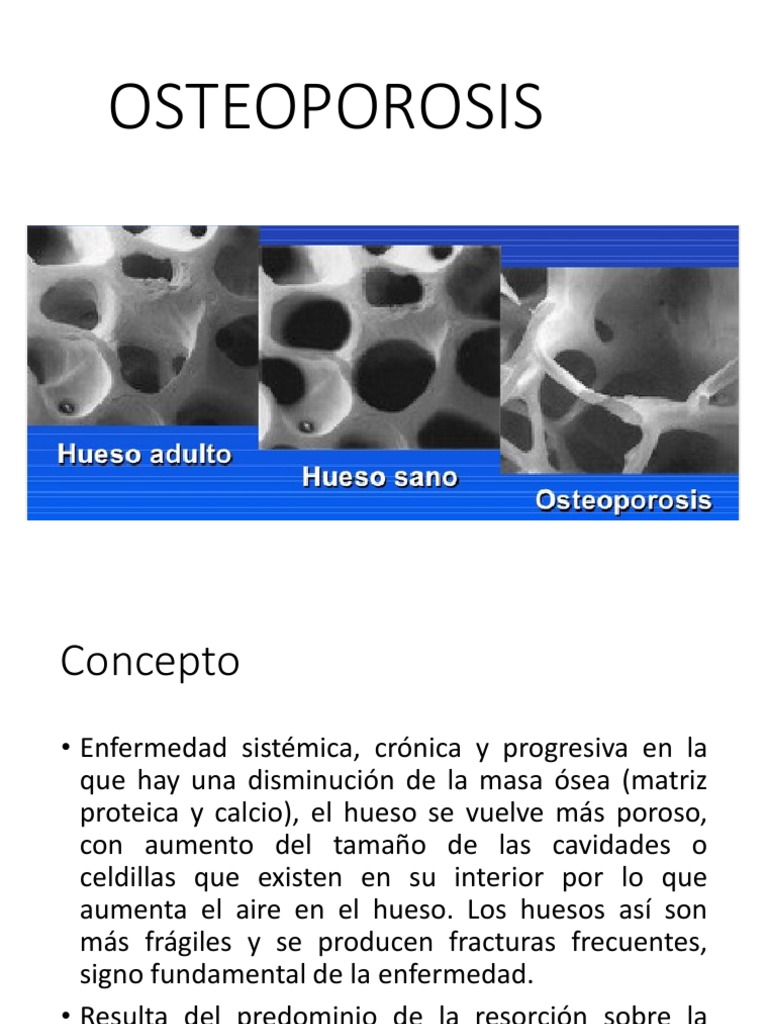 Guía Completa sobre Osteoporosis | PDF | Osteoporosis | Hueso