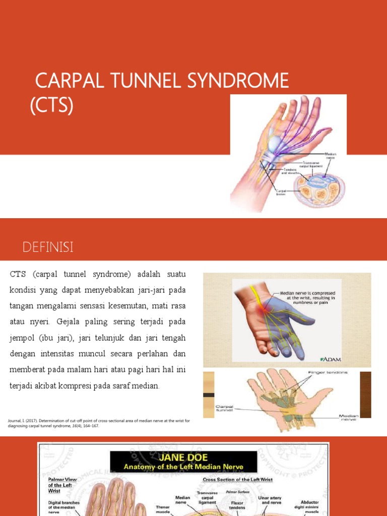 Carpal Tunnel Syndrome | PDF
