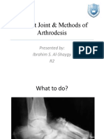 Charcot Joint & Methods of Arthrodesis