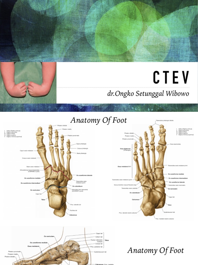 CTEV Congenital Talipes Equinovarus PDF Congenital Disorder Foot