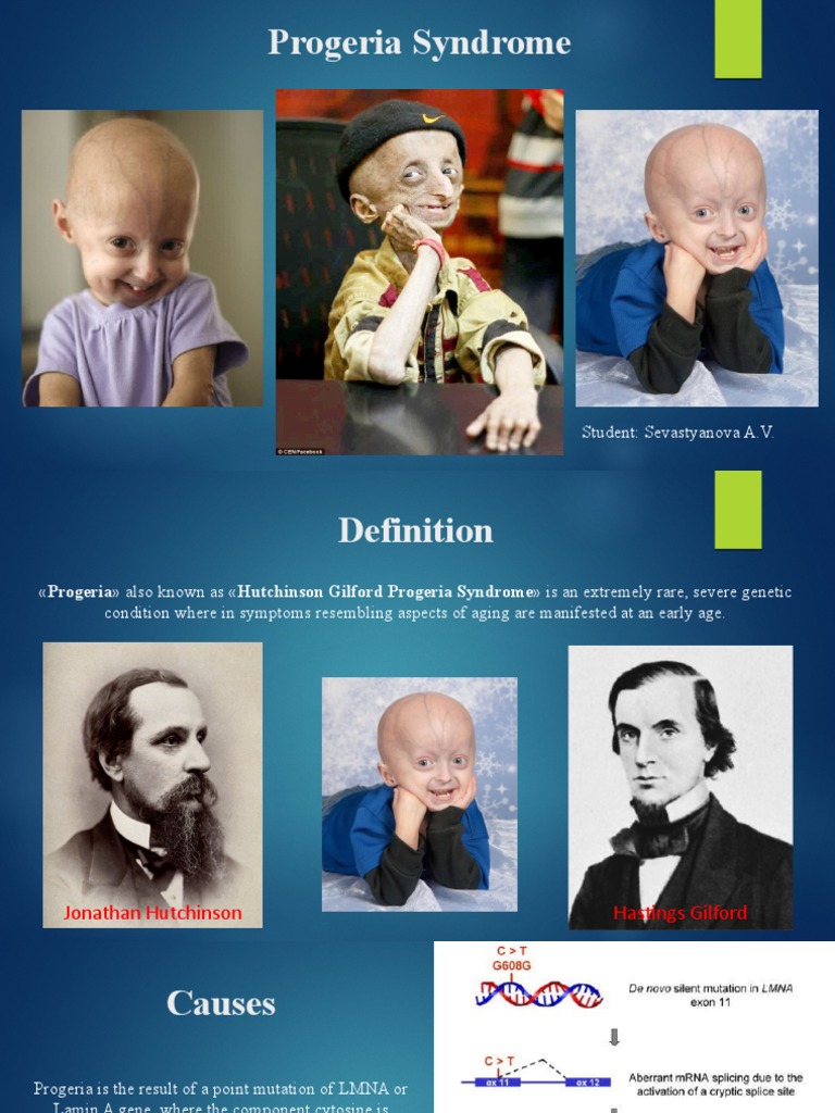 Progeria Syndrome: Student: Sevastyanova A.V | PDF