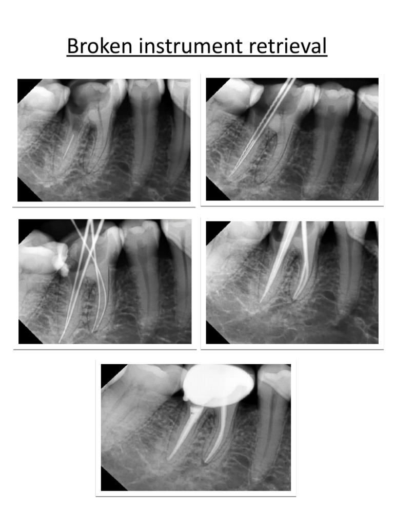 Broken Instrument Retrieval | PDF